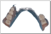 画像：コバルトクロム床義歯のつめもの