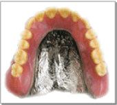 画像：コバルトクロム床義歯
