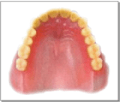 画像：プラスチック義歯
