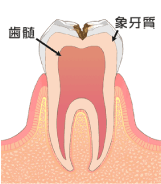イラスト：虫歯C2の状態