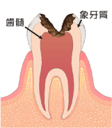 イラスト：虫歯C3の状態