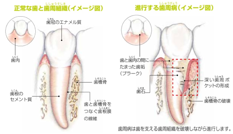 イラスト：正常な鳩歯周組織(イメージ図)と進行する歯周病(イメージ図)